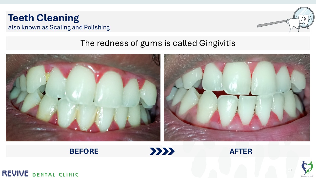 Before and after dental treatment — Revive Dental Clinic, Pune (case 5 of 22)