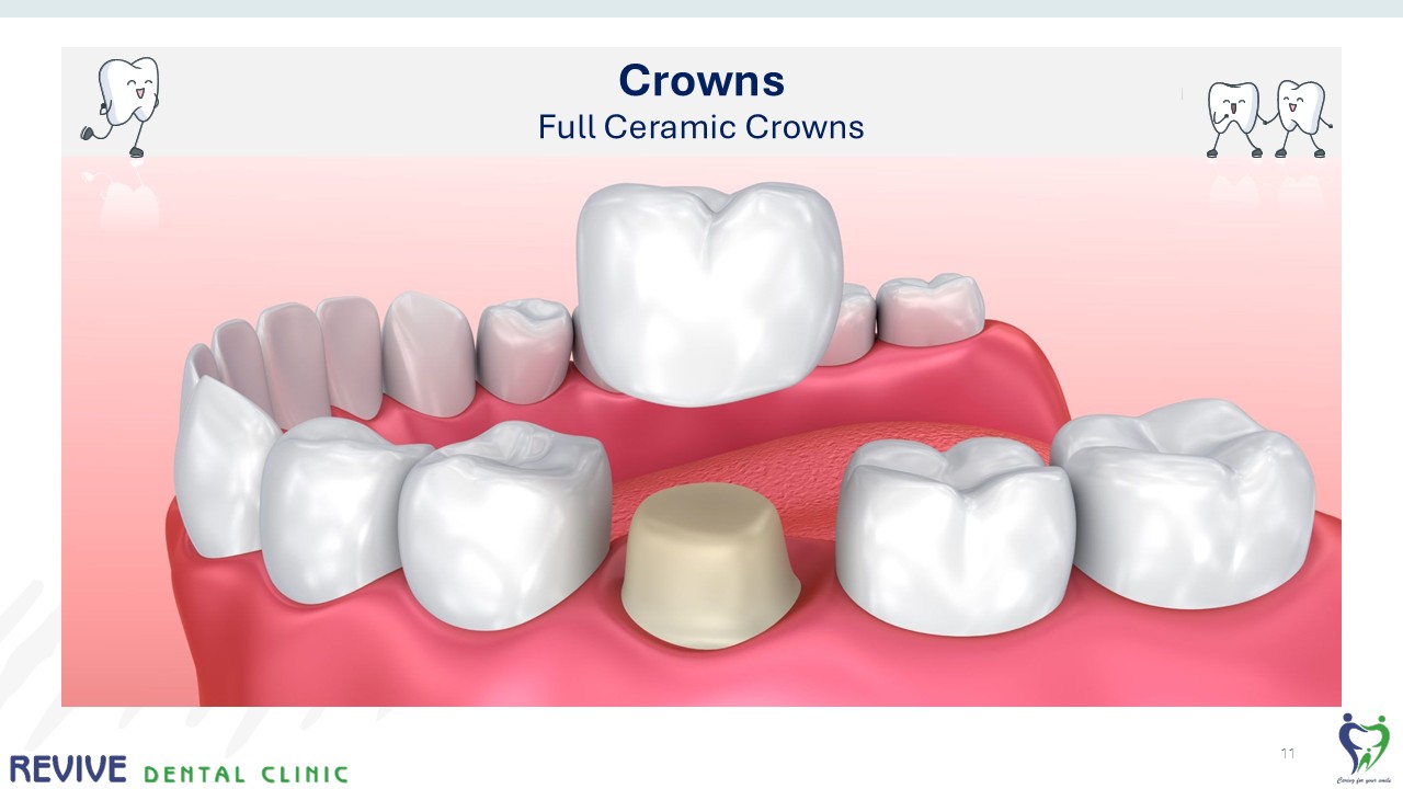 Before and after dental treatment — Revive Dental Clinic, Pune (case 6 of 22)