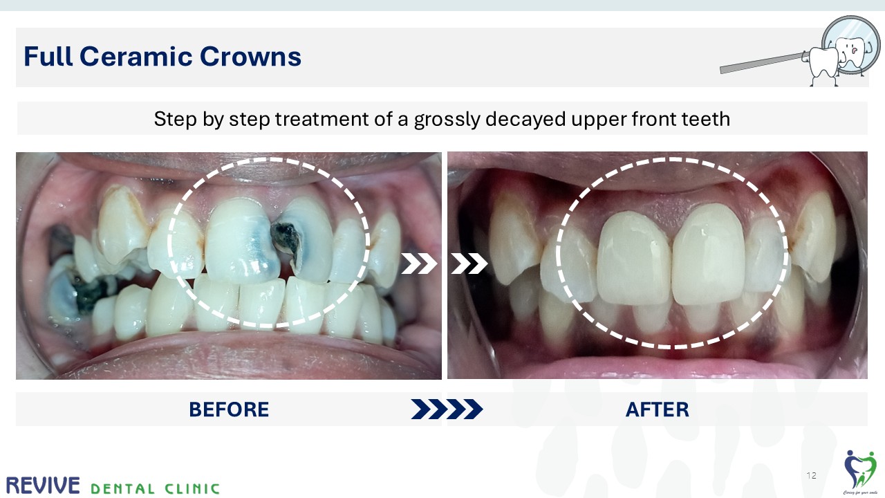 Before and after dental treatment — Revive Dental Clinic, Pune (case 7 of 22)