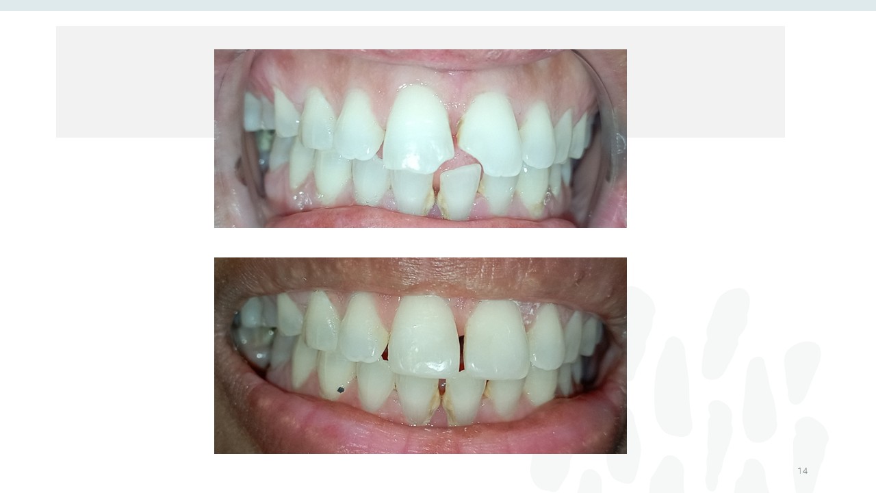 Before and after dental treatment — Revive Dental Clinic, Pune (case 9 of 22)