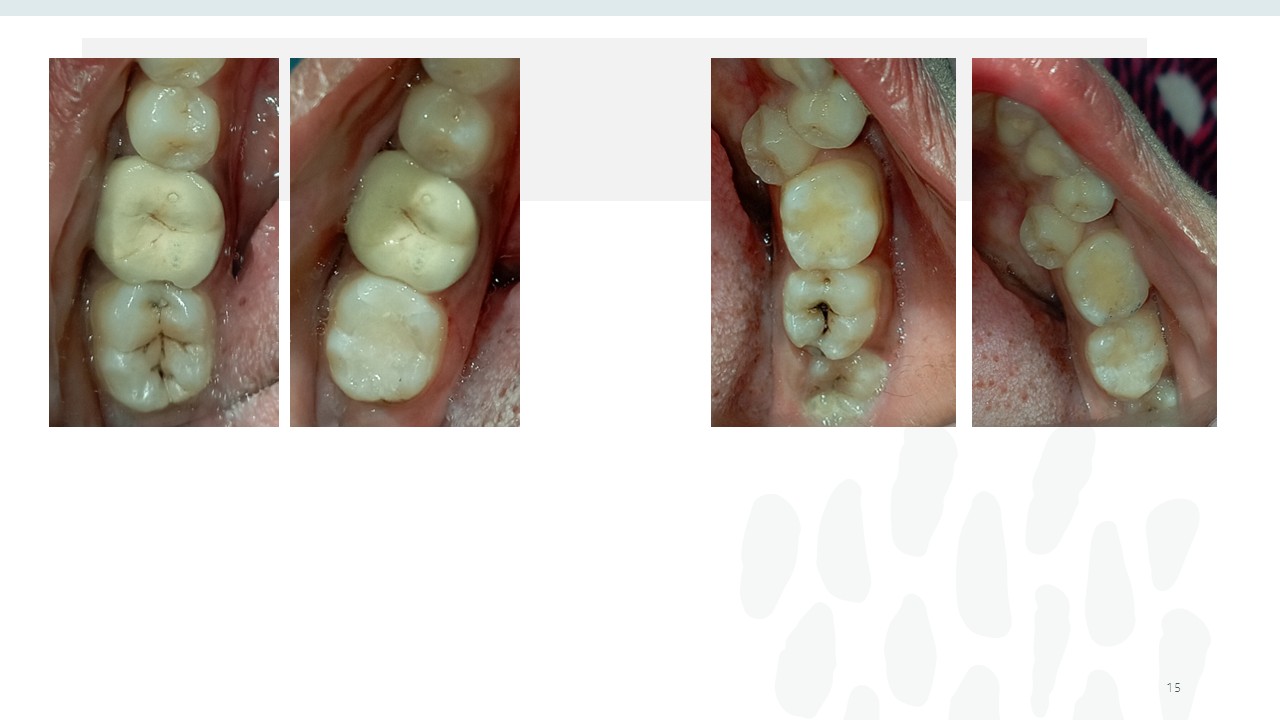 Before and after dental treatment — Revive Dental Clinic, Pune (case 10 of 22)