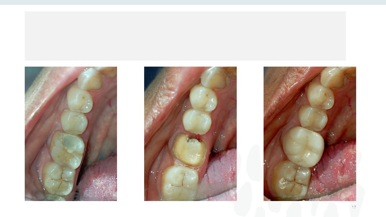 Before and after dental treatment — Revive Dental Clinic, Pune (case 11 of 22)