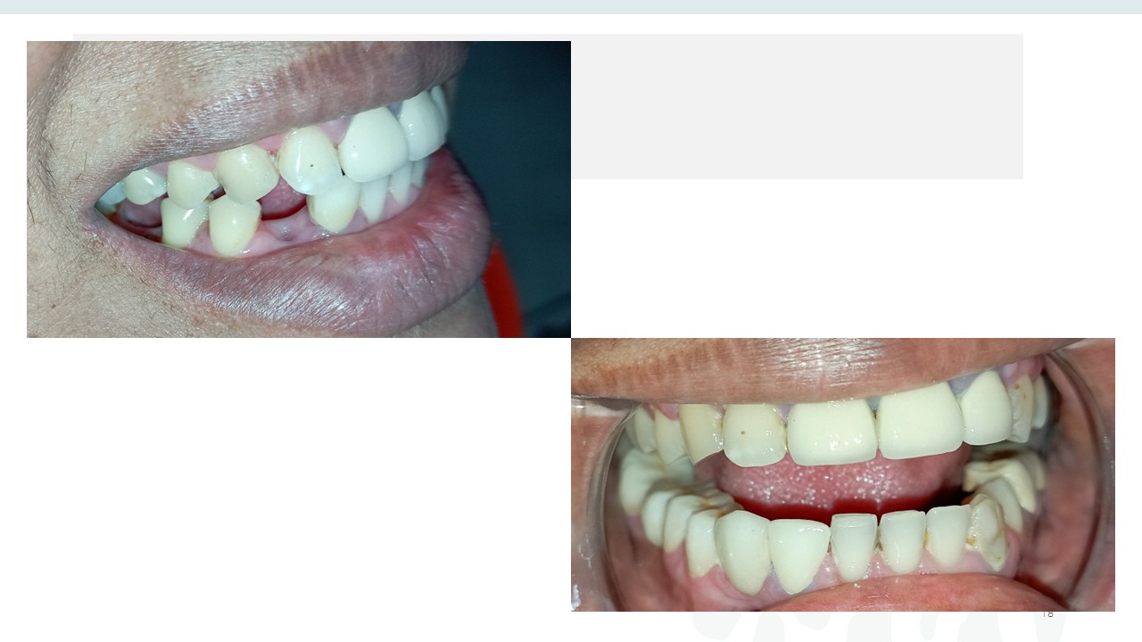 Before and after dental treatment — Revive Dental Clinic, Pune (case 12 of 22)
