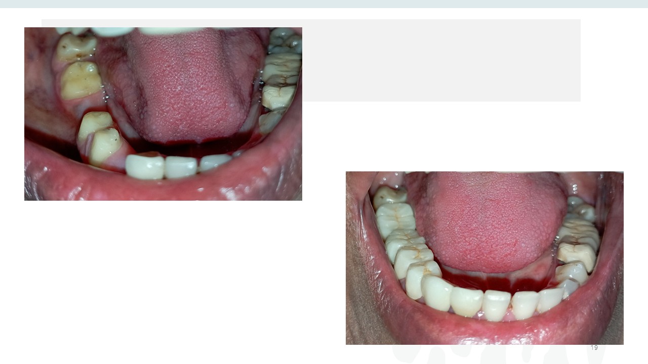 Before and after dental treatment — Revive Dental Clinic, Pune (case 13 of 22)