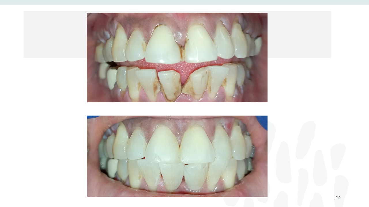 Before and after dental treatment — Revive Dental Clinic, Pune (case 14 of 22)