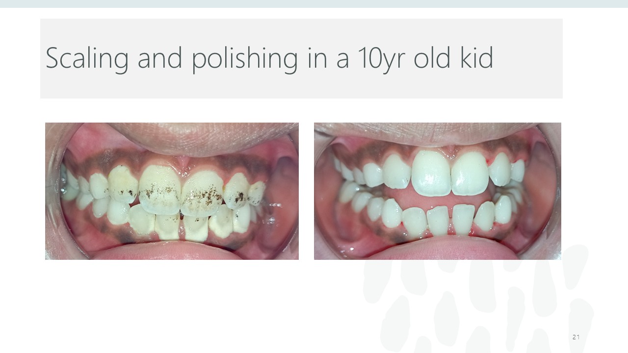 Before and after dental treatment — Revive Dental Clinic, Pune (case 15 of 22)