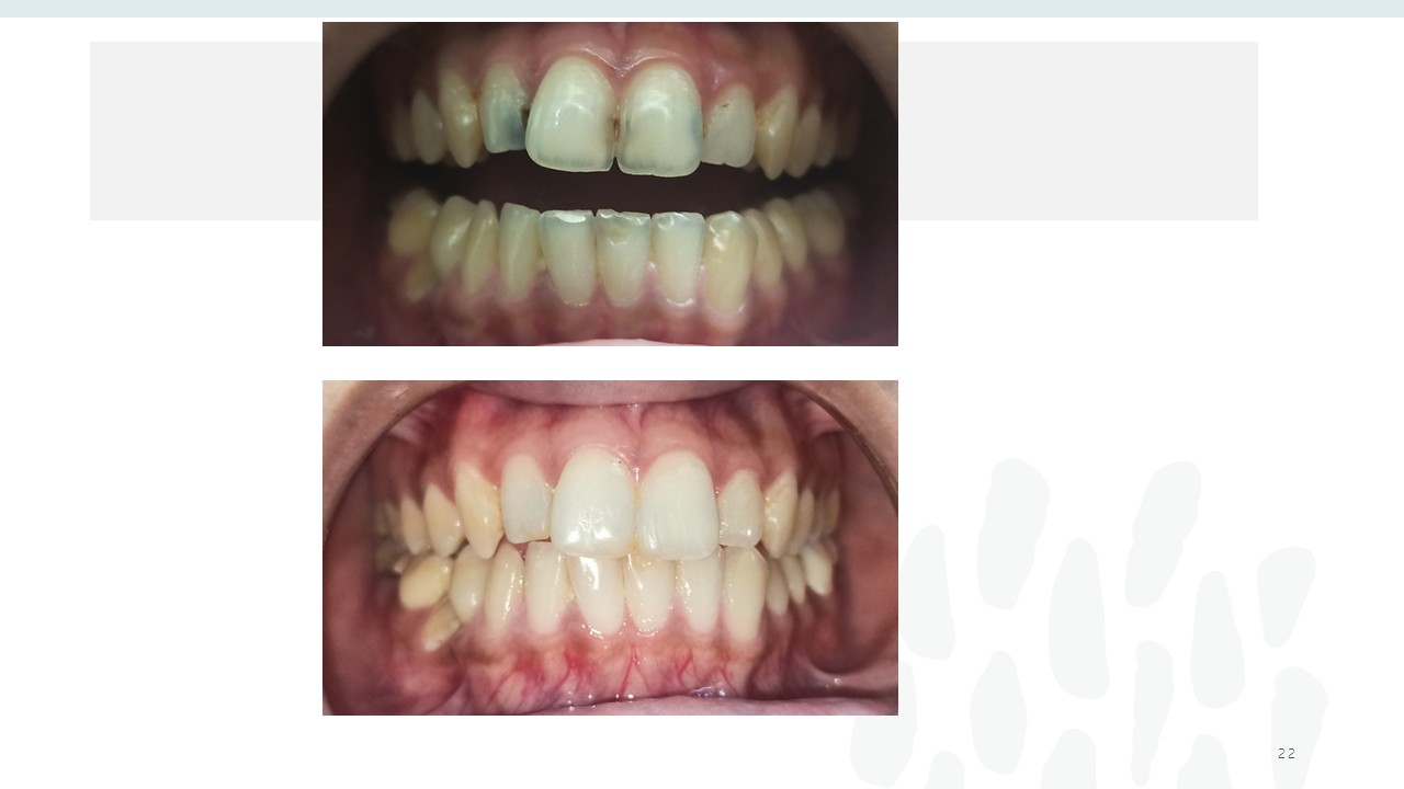 Before and after dental treatment — Revive Dental Clinic, Pune (case 16 of 22)