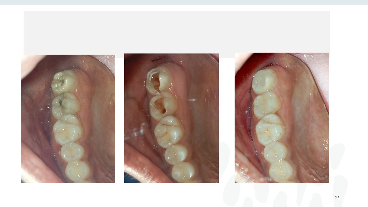 Before and after dental treatment — Revive Dental Clinic, Pune (case 17 of 22)