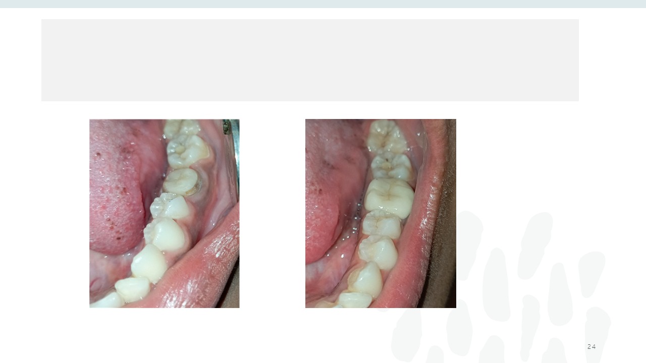 Before and after dental treatment — Revive Dental Clinic, Pune (case 18 of 22)