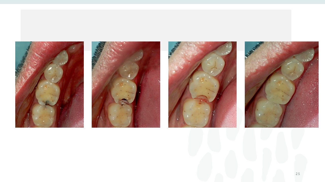 Before and after dental treatment — Revive Dental Clinic, Pune (case 19 of 22)