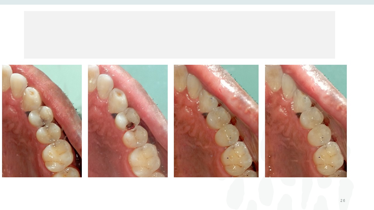 Before and after dental treatment — Revive Dental Clinic, Pune (case 20 of 22)