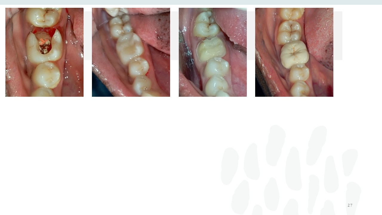 Before and after dental treatment — Revive Dental Clinic, Pune (case 21 of 22)