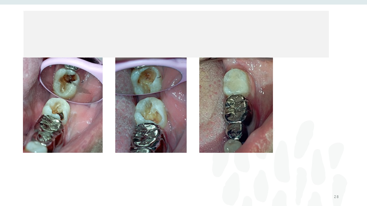 Before and after dental treatment — Revive Dental Clinic, Pune (case 22 of 22)