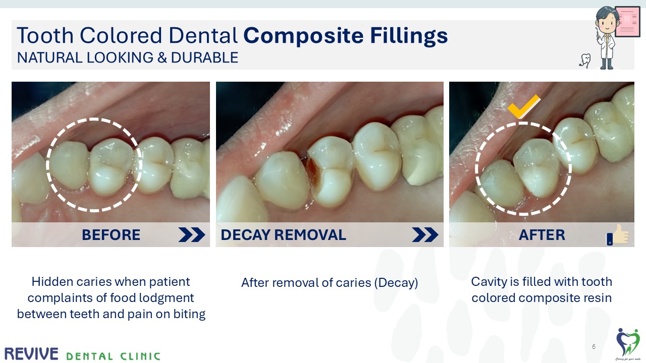 Before and after dental treatment — Revive Dental Clinic, Pune (case 1 of 22)