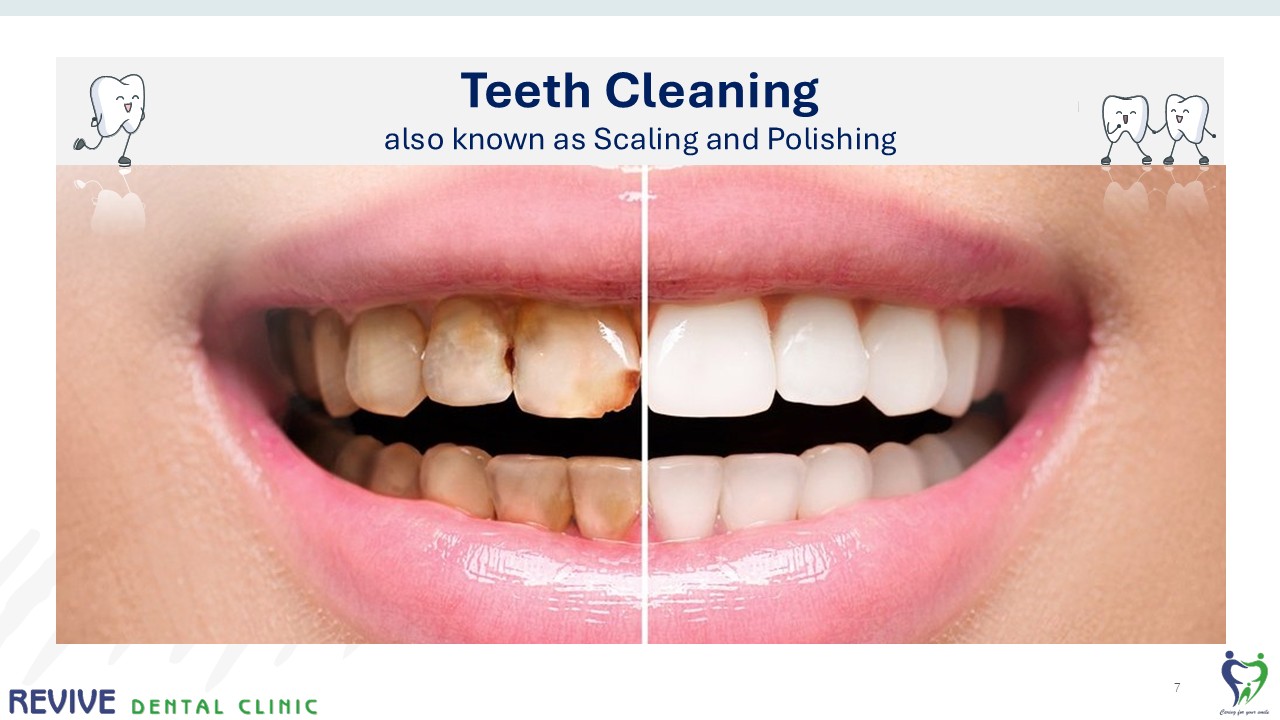 Before and after dental treatment — Revive Dental Clinic, Pune (case 2 of 22)