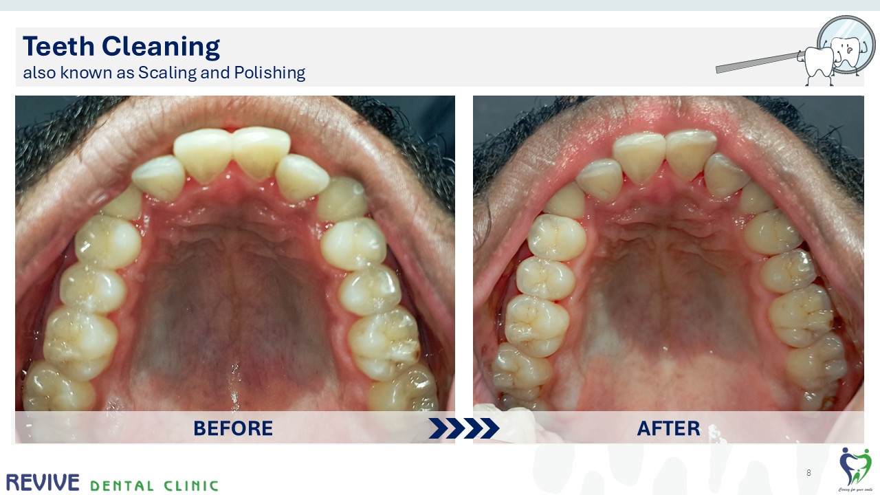 Before and after dental treatment — Revive Dental Clinic, Pune (case 3 of 22)