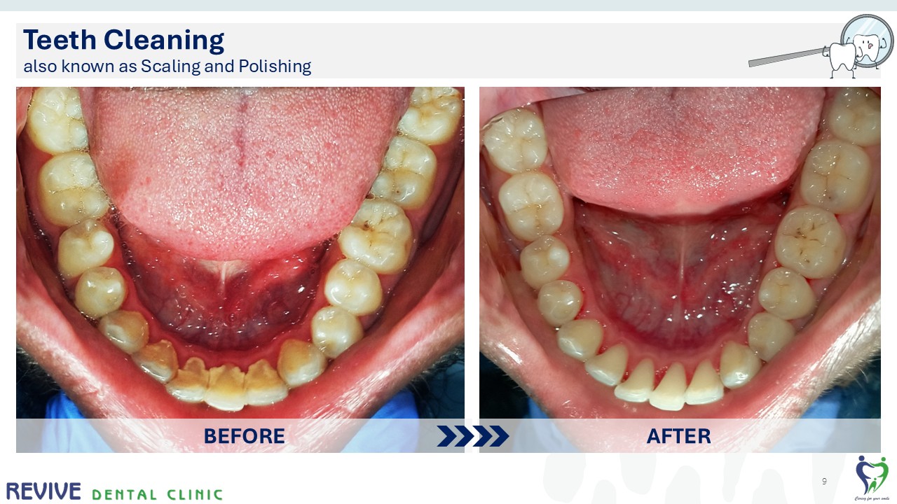 Before and after dental treatment — Revive Dental Clinic, Pune (case 4 of 22)